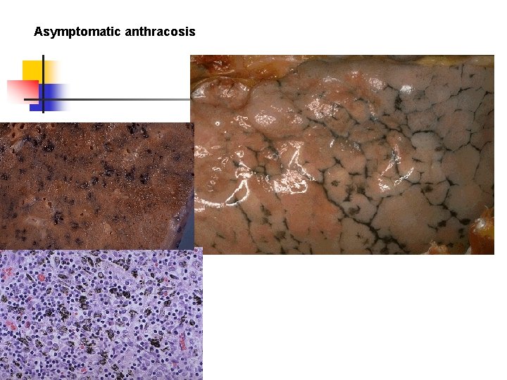 Asymptomatic anthracosis 