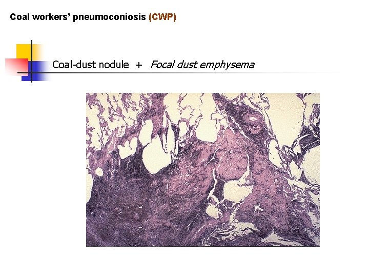 Coal workers’ pneumoconiosis (CWP) Coal-dust nodule + Focal dust emphysema 