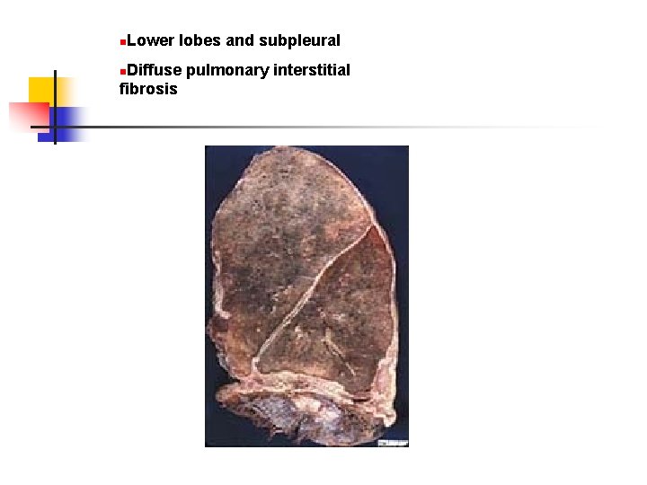 Lower lobes and subpleural n Diffuse pulmonary interstitial fibrosis n 