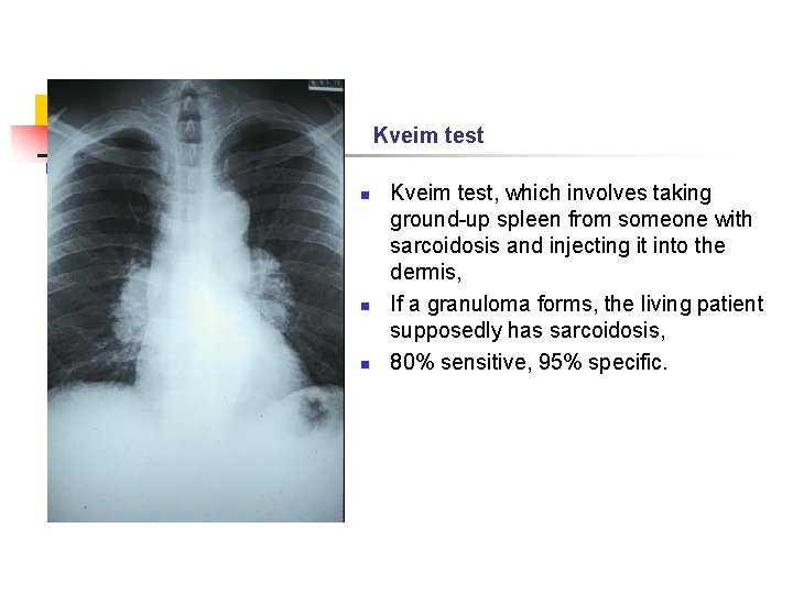 Kveim test n n n Kveim test, which involves taking ground-up spleen from someone