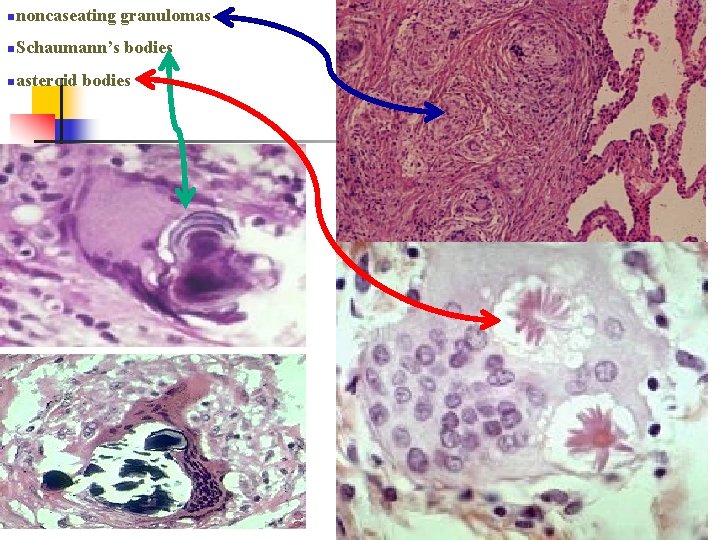 nnoncaseating n. Schaumann’s nasteroid granulomas bodies 