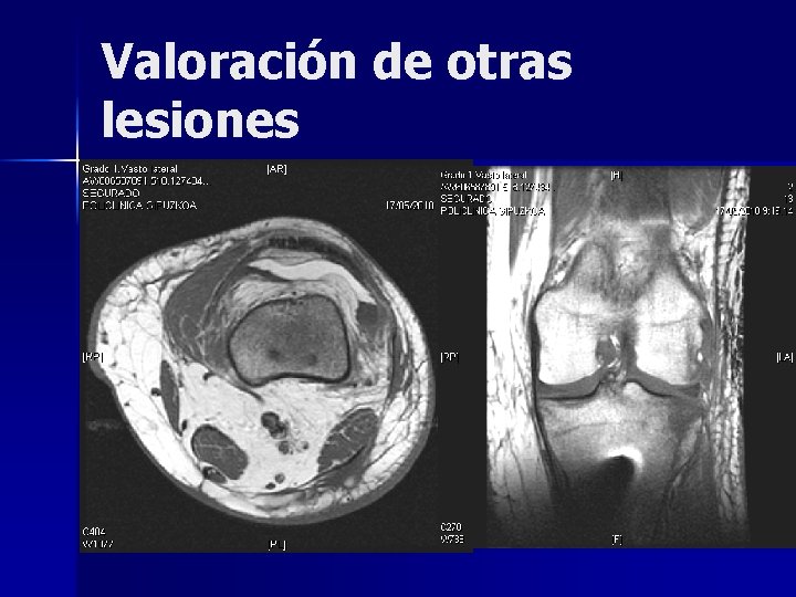 Valoración de otras lesiones Valoración de otras lesiones