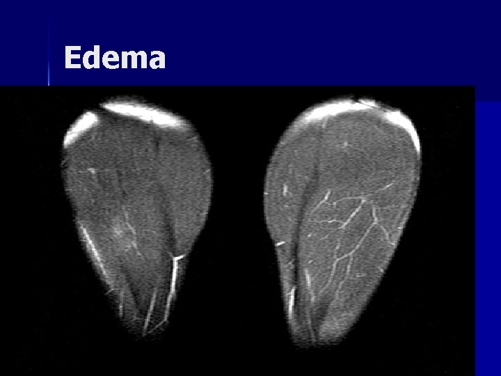 Edema Edema