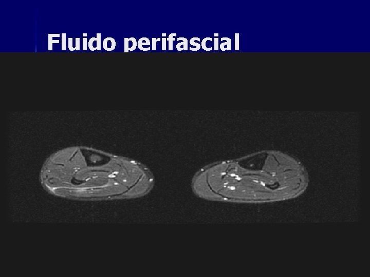Fluido perifascial Fluido perifascial