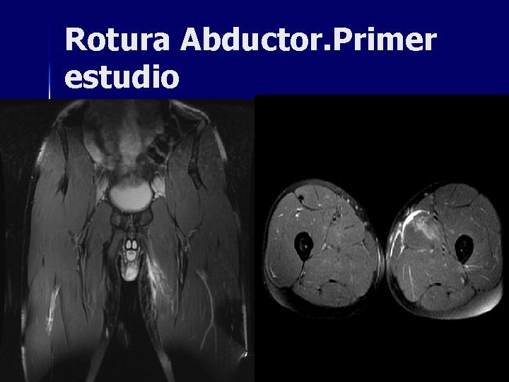 Rotura Abductor. Primer estudio Rotura Abductor. Primer estudio