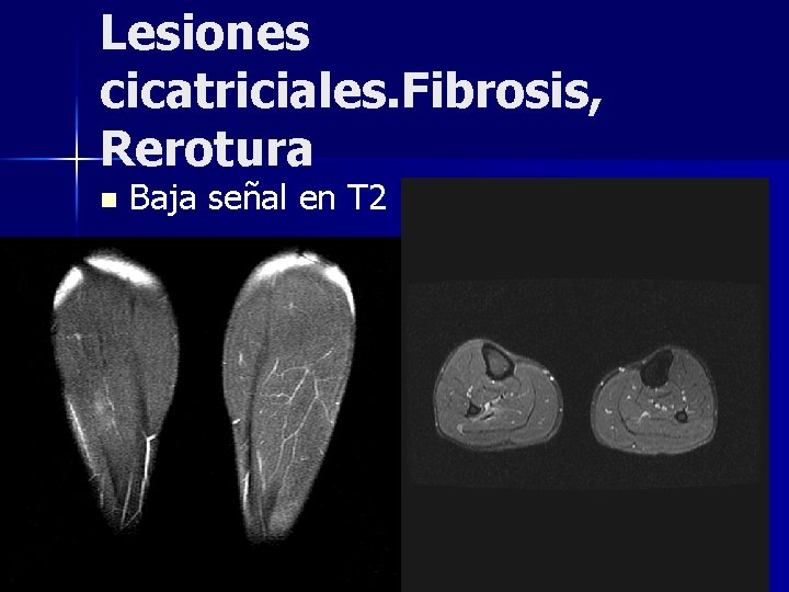 Lesiones cicatriciales. Fibrosis, Rerotura n Baja señal en T 2 Lesiones cicatriciales. Fibrosis, Rerotura n Baja señal en T 2