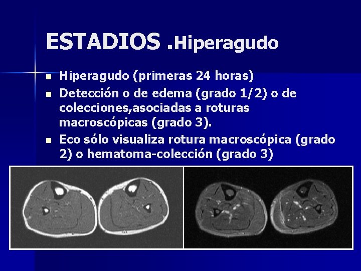 ESTADIOS. Hiperagudo n n n Hiperagudo (primeras 24 horas) Detección o de edema (grado ESTADIOS. Hiperagudo n n n Hiperagudo (primeras 24 horas) Detección o de edema (grado