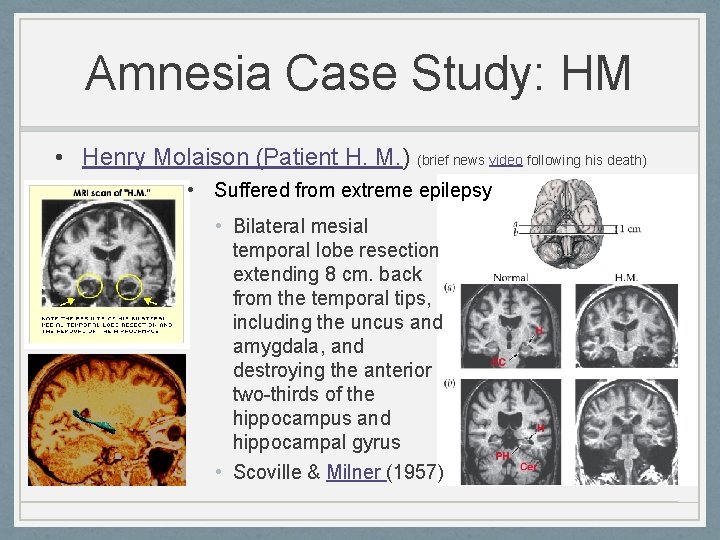Amnesia Case Study: HM • Henry Molaison (Patient H. M. ) (brief news video Amnesia Case Study: HM • Henry Molaison (Patient H. M. ) (brief news video