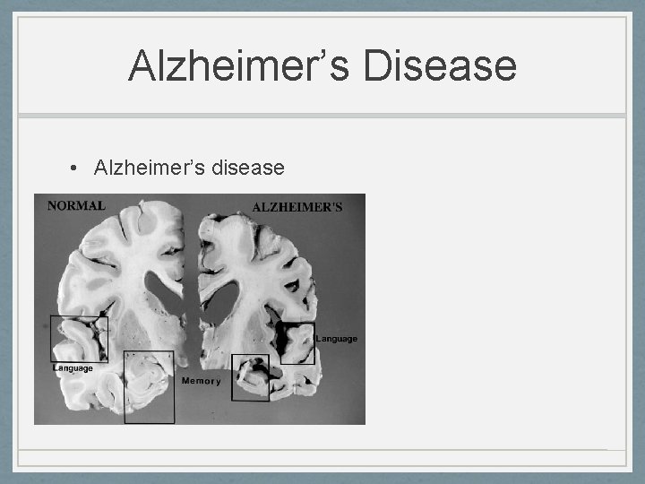 Alzheimer’s Disease • Alzheimer’s disease 