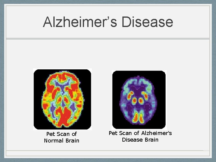 Alzheimer’s Disease Pet Scan of Normal Brain Pet Scan of Alzheimer’s Disease Brain 