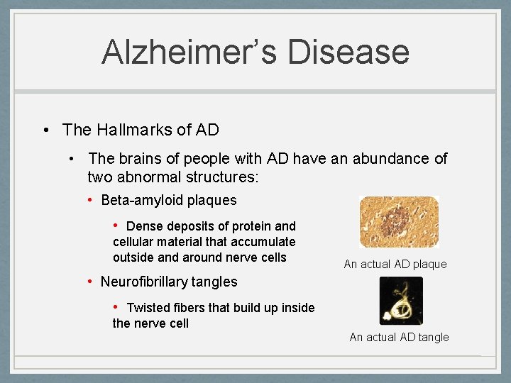 Alzheimer’s Disease • The Hallmarks of AD • The brains of people with AD