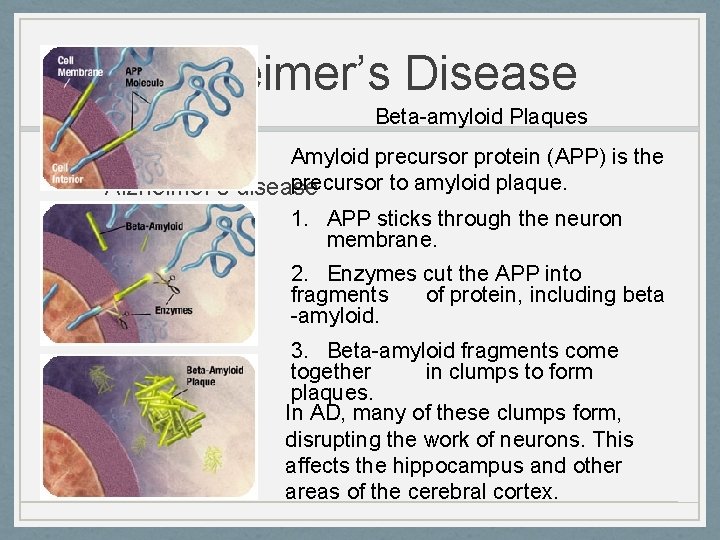 Alzheimer’s Disease Beta-amyloid Plaques Amyloid precursor protein (APP) is the precursor to amyloid plaque.