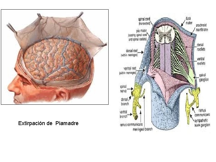 Extirpación de Piamadre 