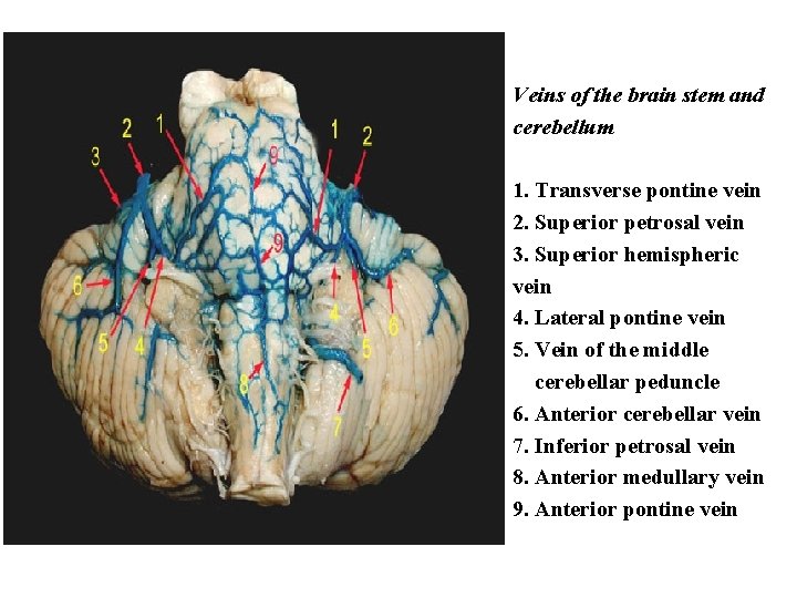 Veins of the brain stem and cerebellum 1. Transverse pontine vein 2. Superior petrosal