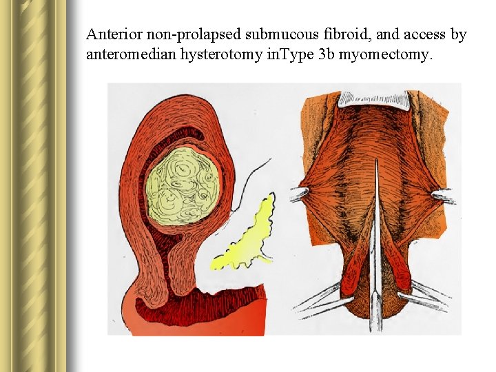 Anterior non-prolapsed submucous ﬁbroid, and access by anteromedian hysterotomy in. Type 3 b myomectomy.