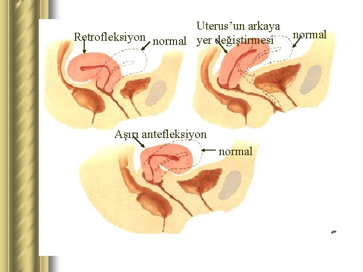Uterus’un arkaya Retrofleksiyon normal yer değiştirmesi Aşırı antefleksiyon normal 