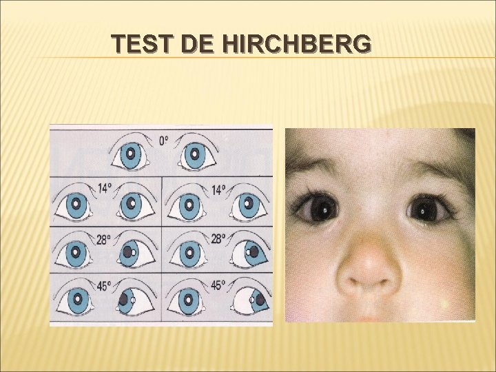 TEST DE HIRCHBERG 