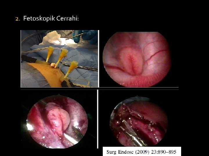 2. Fetoskopik Cerrahi: 