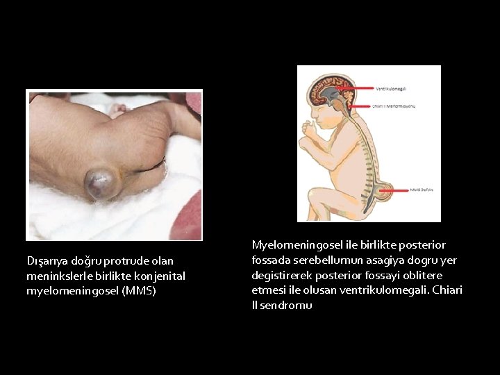 Dışarıya doğru protrude olan meninkslerle birlikte konjenital myelomeningosel (MMS) Myelomeningosel ile birlikte posterior fossada