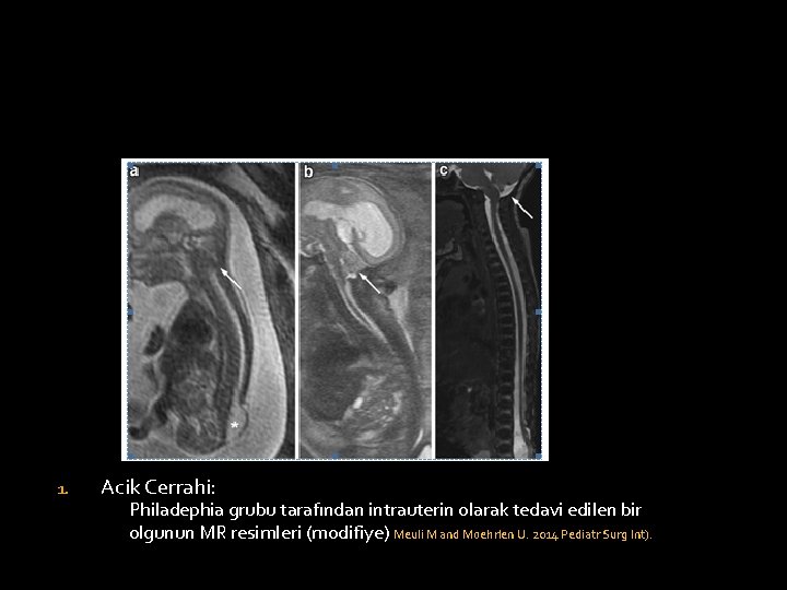 1. Acik Cerrahi: Philadephia grubu tarafından intrauterin olarak tedavi edilen bir olgunun MR resimleri