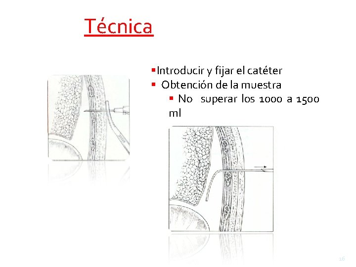 Técnica Introducir y fijar el catéter Obtención de la muestra No superar los 1000