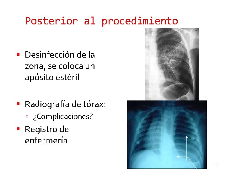 Posterior al procedimiento Desinfección de la zona, se coloca un apósito estéril Radiografía de