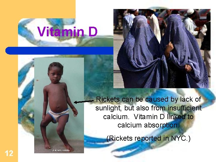 Vitamin D Rickets can be caused by lack of sunlight, but also from insufficient