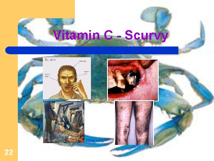 Vitamin C - Scurvy 22 