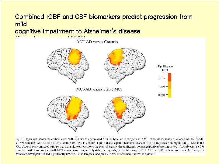 CSF Assay Mild Cognitive Impairment Clinical Dementia Rating