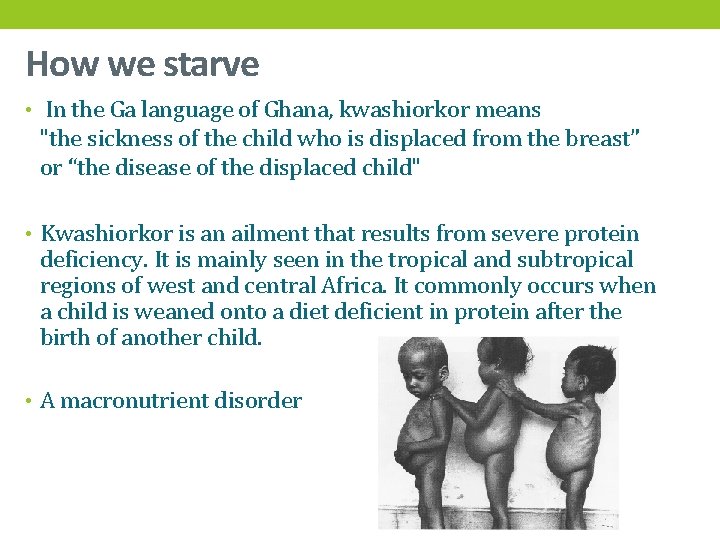 How we starve • In the Ga language of Ghana, kwashiorkor means "the sickness