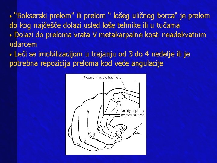  • "Bokserski prelom" ili prelom " lošeg uličnog borca" je prelom do kog