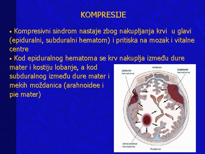 KOMPRESIJE • Kompresivni sindrom nastaje zbog nakupljanja krvi u glavi (epiduralni, subduralni hematom) i