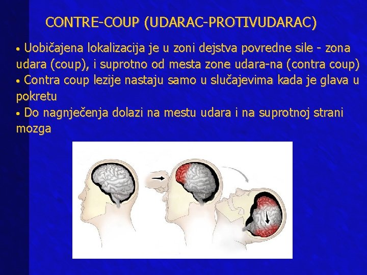 CONTRE-COUP (UDARAC-PROTIVUDARAC) • Uobičajena lokalizacija je u zoni dejstva povredne sile - zona udara