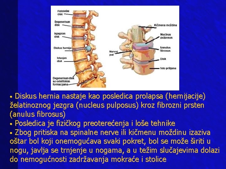  • Diskus hernia nastaje kao posledica prolapsa (hernijacije) želatinoznog jezgra (nucleus pulposus) kroz