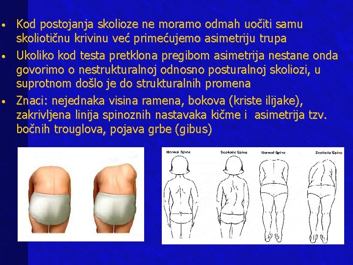  • • • Kod postojanja skolioze ne moramo odmah uočiti samu skoliotičnu krivinu
