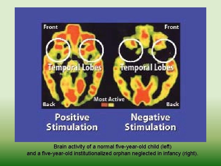 Brain activity of a normal five-year-old child (left) and a five-year-old institutionalized orphan neglected