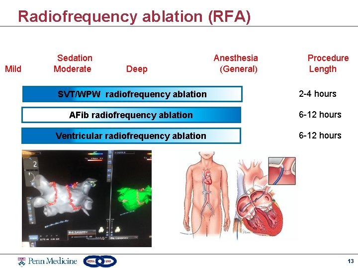 Radiofrequency ablation (RFA) Mild Sedation Moderate Deep Anesthesia (General) Procedure Length SVT/WPW radiofrequency ablation