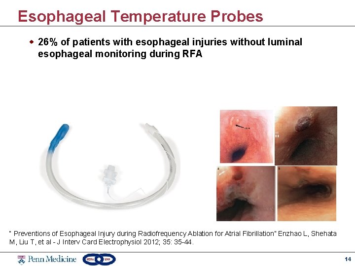 Esophageal Temperature Probes w 26% of patients with esophageal injuries without luminal esophageal monitoring