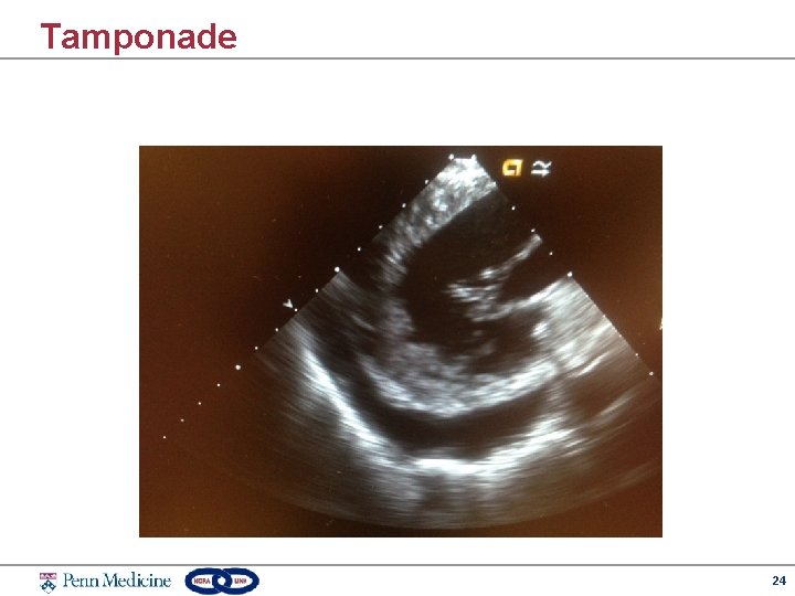 Tamponade 24 