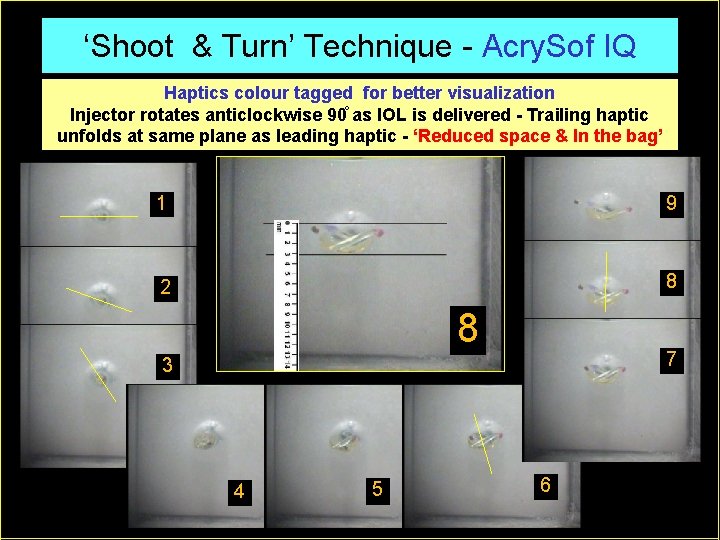 ‘Shoot & Turn’ Technique - Acry. Sof IQ Haptics colour tagged for better visualization