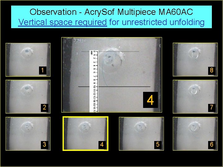 Observation - Acry. Sof Multipiece MA 60 AC Vertical space required for unrestricted unfolding