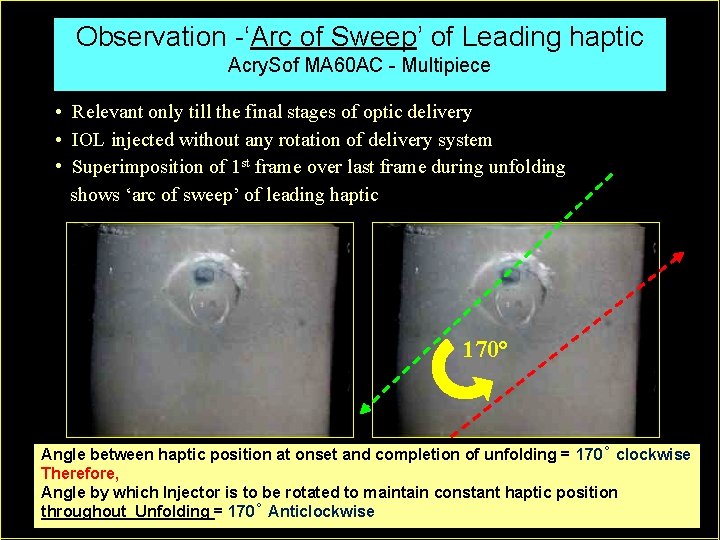 Observation -‘Arc of Sweep’ of Leading haptic Acry. Sof MA 60 AC - Multipiece