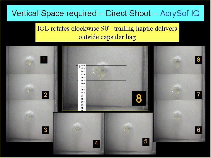 Vertical Space required – Direct Shoot – Acry. Sof IQ IOL rotates clockwise 90