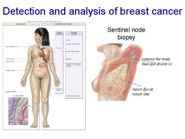 Detection and analysis of breast cancer Sentinel node biopsy 