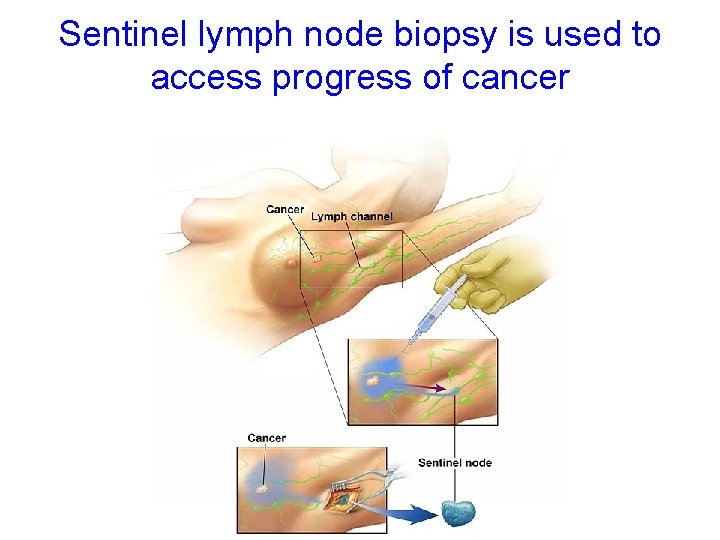 Sentinel lymph node biopsy is used to access progress of cancer 