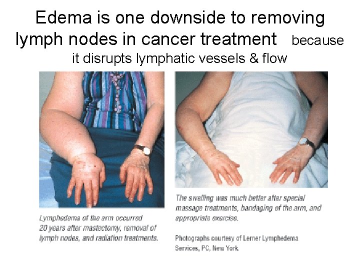 Edema is one downside to removing lymph nodes in cancer treatment because it disrupts