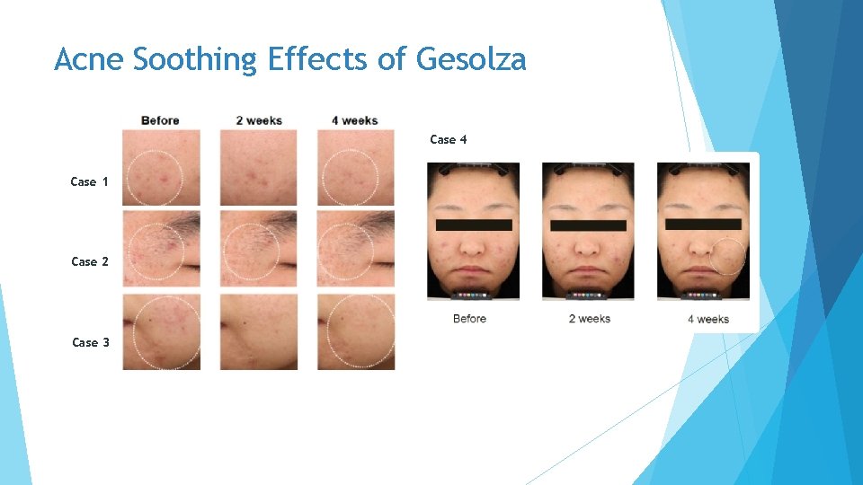 Acne Soothing Effects of Gesolza Case 4 Case 1 Case 2 Case 3 