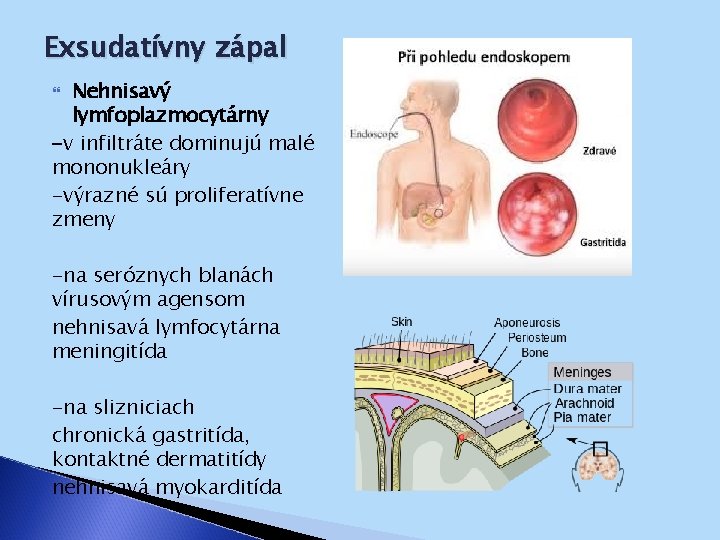 Exsudatívny zápal Nehnisavý lymfoplazmocytárny -v infiltráte dominujú malé mononukleáry -výrazné sú proliferatívne zmeny -na