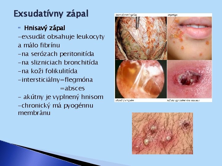 Exsudatívny zápal Hnisavý zápal -exsudát obsahuje leukocyty a málo fibrínu -na serózach peritonitída -na