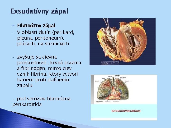 Exsudatívny zápal - - Fibrinózny zápal V oblasti dutín (perikard, pleura, peritoneum), pĺúcach, na